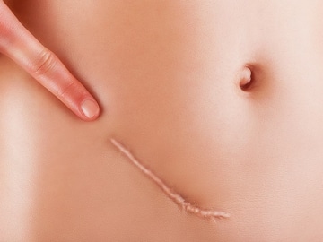 Correção de cicatrizes