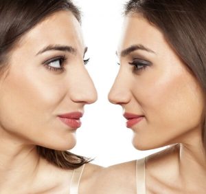Rinoplastia